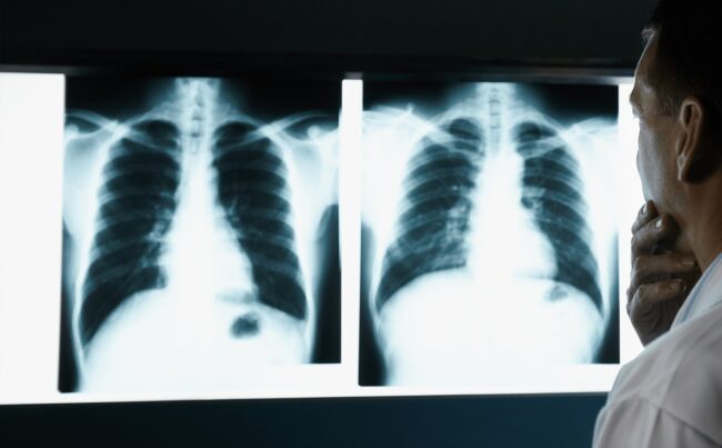 Akciğer Kanseri Akciger-Kanseri