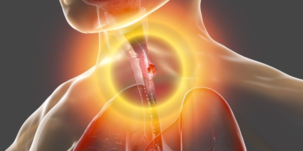 Esophageal Cancer Esophageal Cancer