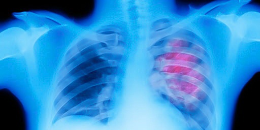 Mediastinal Cancers Mediastinal Cancers