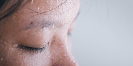 Hiperhidroz Hiperhidroz