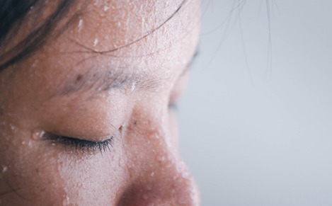 Hiperhidroz Hiperhidroz