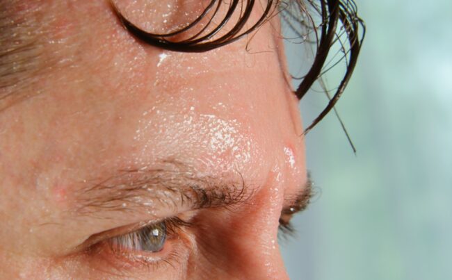 Sympathectomy Sympathectomy