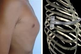 Carinatum -Ambramson