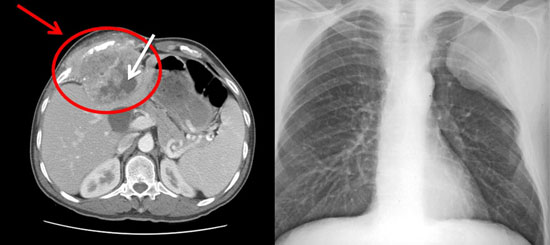 Chest Wall Deformity Chest Wall Deformity