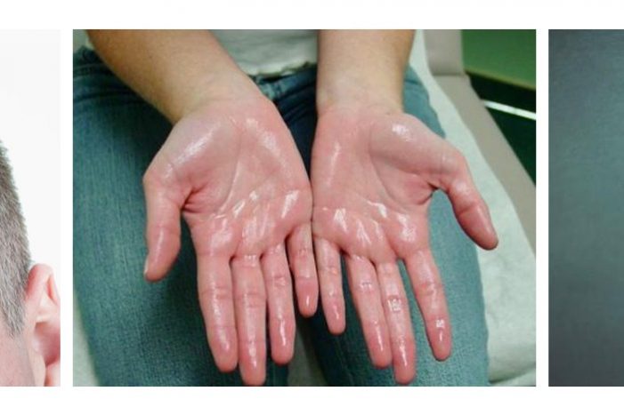 Hyperhidrosis, Sweating, Excessive Sweating, Botox, ETS Sympathectomy,