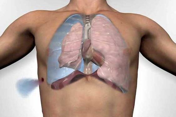 Pnomotoraks-akciger-sonmesi.